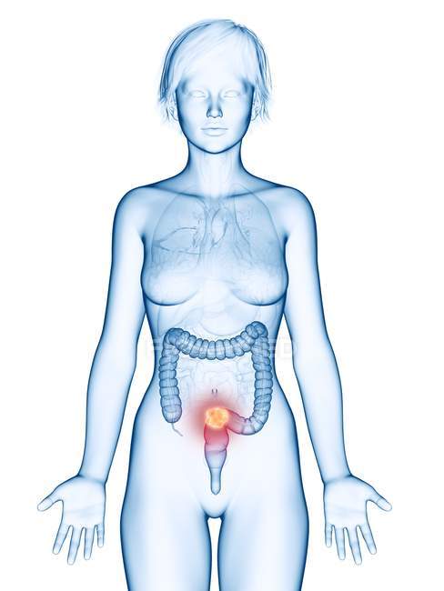 Medizinische Illustration von Dickdarmkrebs in weiblicher Silhouette. — Stockfoto