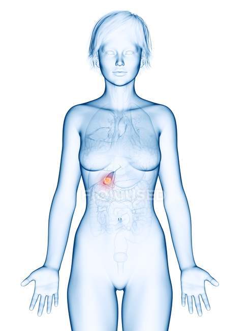 Ilustração médica do câncer de vesícula biliar na silhueta feminina
. — Fotografia de Stock