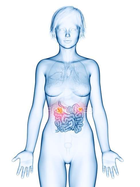 Medizinische Illustration von Dünndarmkrebs in weiblicher Silhouette. — Stockfoto