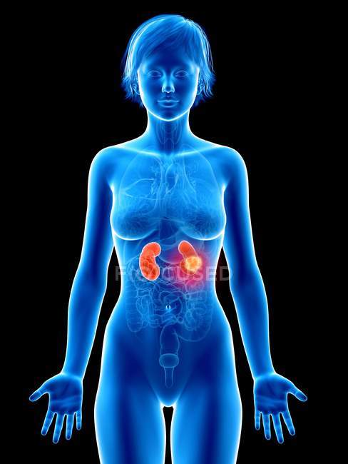 Ilustração médica do câncer renal na silhueta feminina
. — Fotografia de Stock