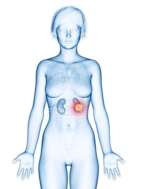 Ilustración médica del cáncer de riñón en la silueta femenina . - foto de stock