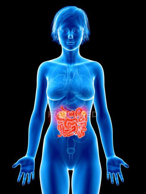 Ilustração médica do câncer de intestino delgado na silhueta feminina . — Fotografia de Stock