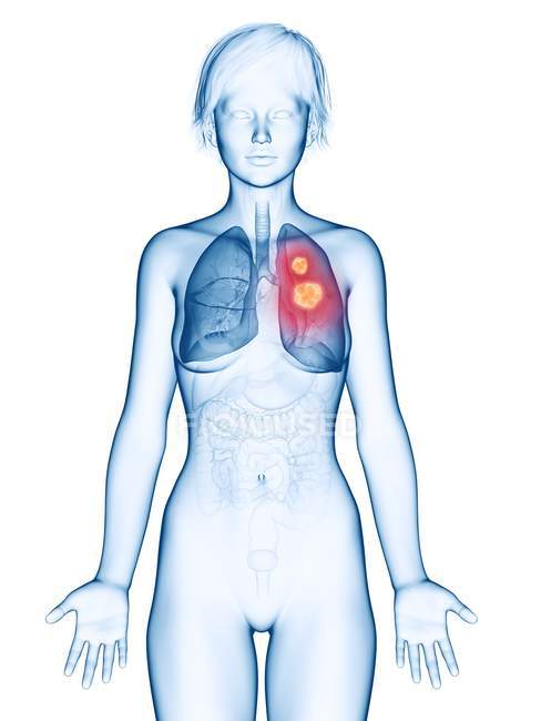 Illustration médicale du cancer du poumon en silhouette féminine
. — Photo de stock
