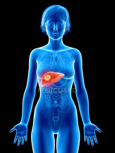 Ilustración médica del cáncer de hígado en la silueta femenina . - foto de stock