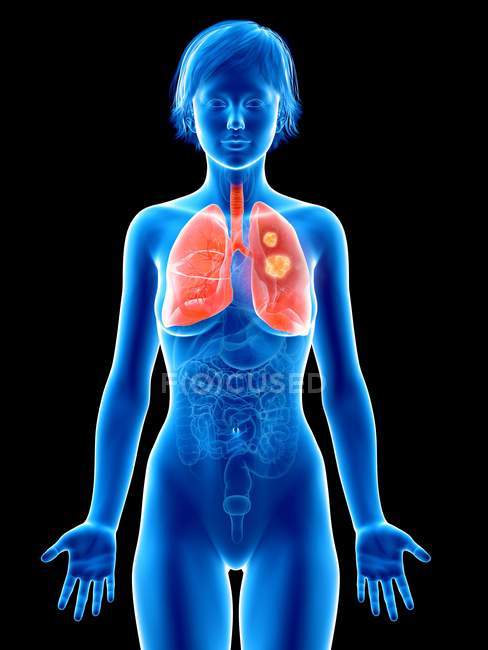 Ilustración médica del cáncer de pulmón en la silueta femenina
. - foto de stock