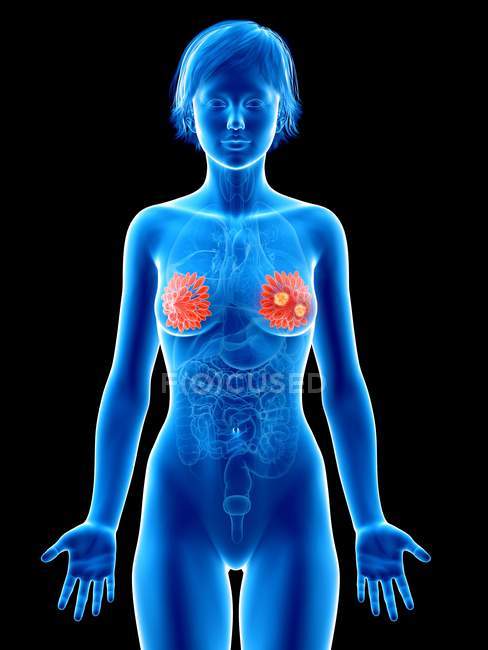 Medical illustration of mammary glands cancer in female silhouette. — Stock Photo