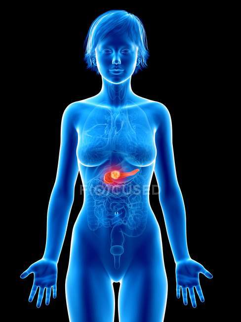 Ilustración médica del cáncer de páncreas en la silueta femenina . - foto de stock