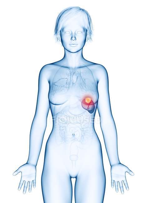 Ilustración médica del cáncer de bazo en la silueta femenina
. - foto de stock