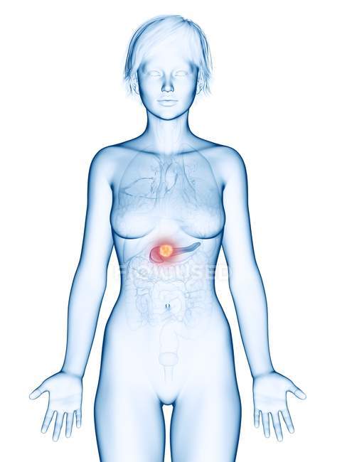 Ilustración médica del cáncer de páncreas en la silueta femenina
. - foto de stock