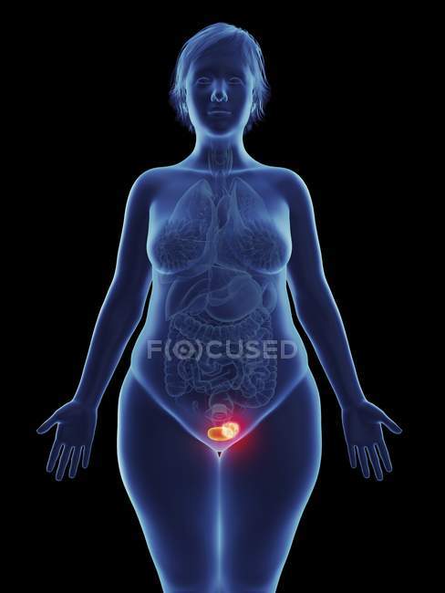 Ілюстрація ракової пухлини в жіночий сечового міхура. — стокове фото
