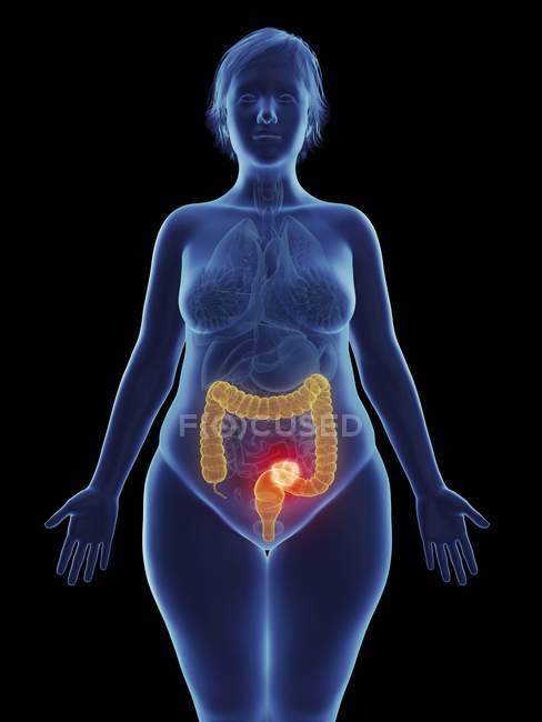 Ilustración de tumor canceroso en el recto femenino . - foto de stock