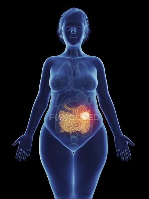 Ilustración de tumor canceroso en el intestino delgado femenino . - foto de stock