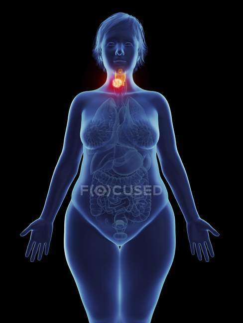 Ilustración de tumor canceroso en laringe femenina . - foto de stock