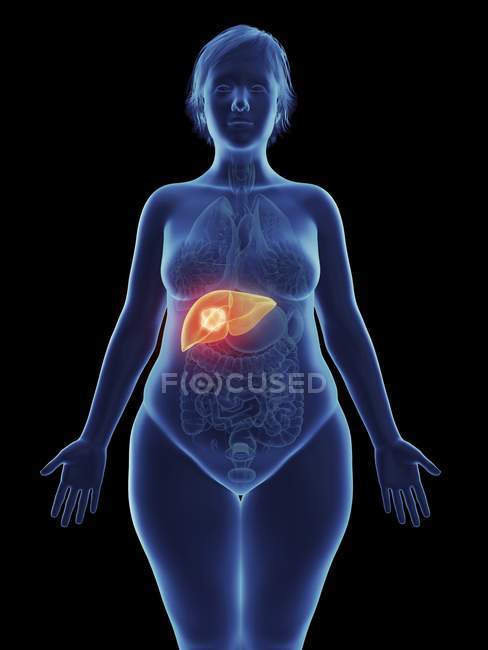 Ilustración de tumor canceroso en el hígado femenino . - foto de stock