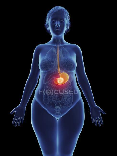 Illustration de tumeur cancéreuse dans l'estomac féminin . — Photo de stock