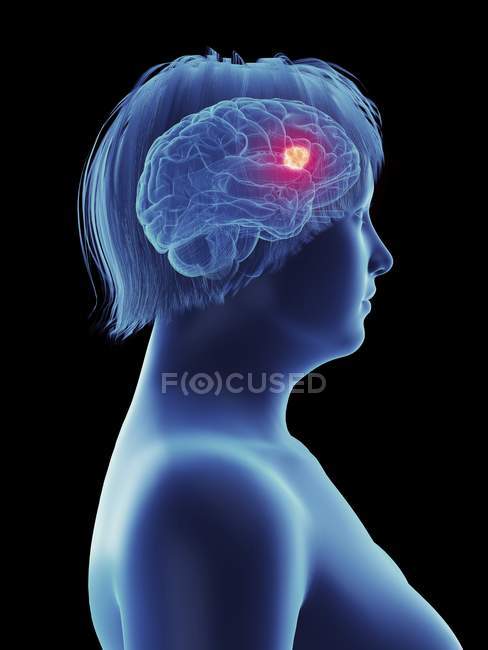 Illustration de tumeur cancéreuse dans le cerveau féminin . — Photo de stock