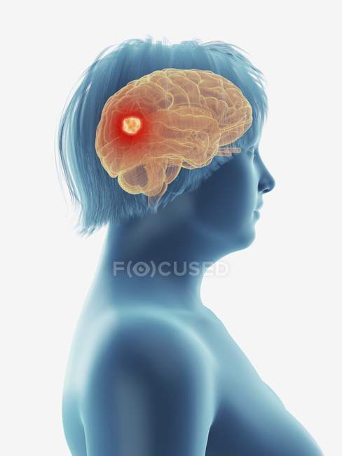 Ilustración de tumor canceroso en el cerebro femenino . - foto de stock