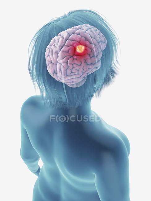 Illustration of cancerous tumour in female brain. — Stock Photo