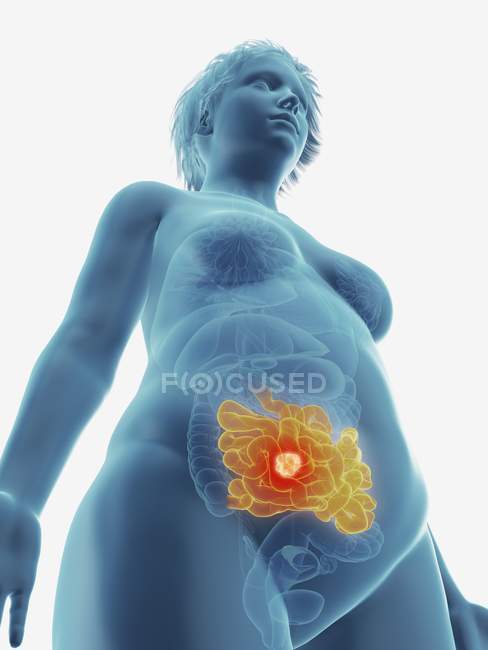 Ilustración de tumor canceroso en el intestino delgado femenino
. - foto de stock