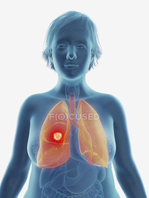 Ілюстрація ракової пухлини в жіночий легенів. — стокове фото