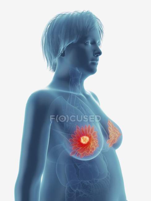 Illustrazione del tumore tumorale nelle ghiandole mammarie femminili . — Foto stock