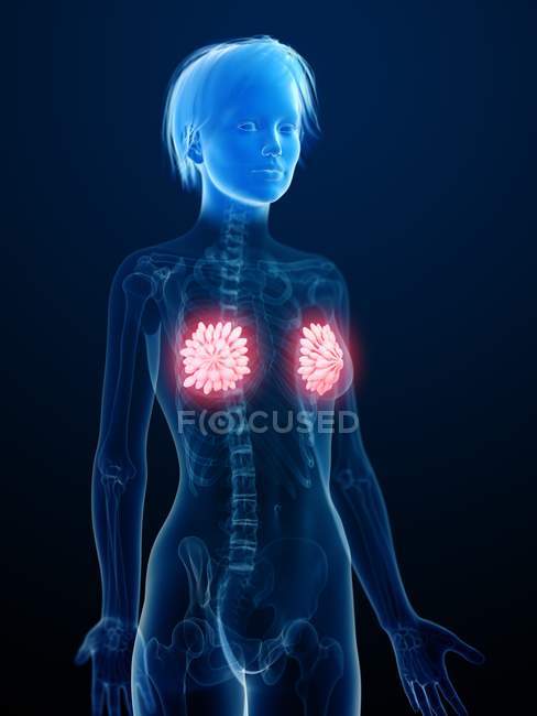 Medical illustration of inflamed mammary glands in female silhouette. — Stock Photo