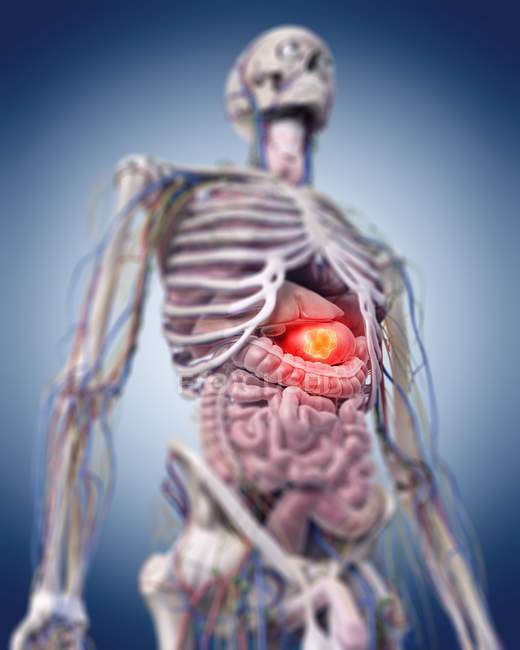 Illustration d'une tumeur de l'estomac dans le corps squelettique humain . — Photo de stock