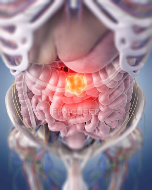 Ilustración del tumor de colon en el cuerpo humano
. - foto de stock
