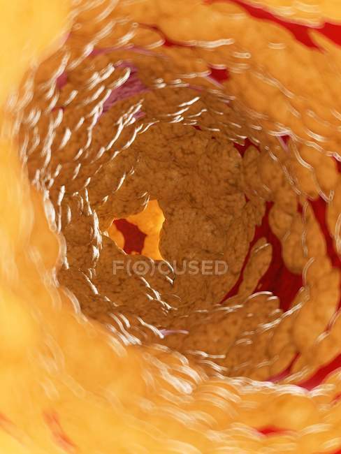 Illustration de graisse à l'intérieur de l'artère humaine . — Photo de stock