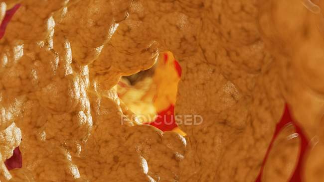 Ilustração da gordura no interior da artéria humana . — Fotografia de Stock