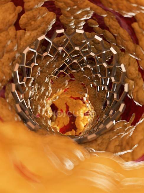 Ілюстрація стенту всередині людської жирової артерії . — стокове фото