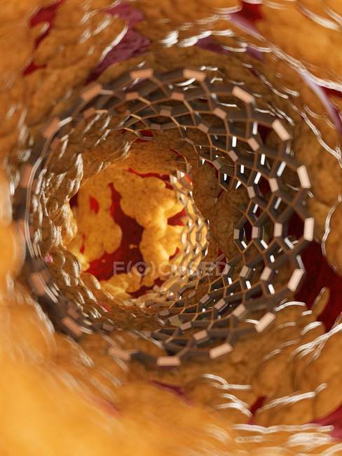 Illustration of stent inside of human fatty artery. — Stock Photo