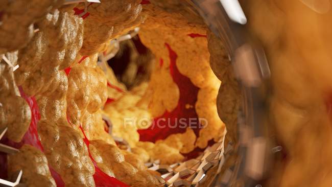Illustrazione dello stent all'interno dell'arteria grassa umana . — Foto stock