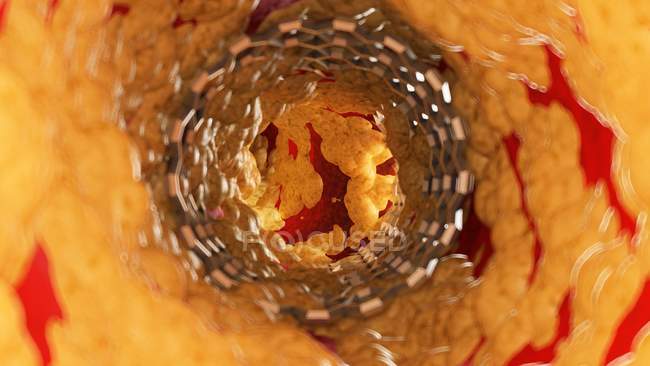 Иллюстрация стента внутри жировой артерии человека
. — стоковое фото