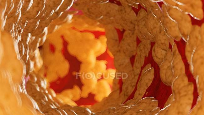 Медична ілюстрація жиру всередині людської артерії . — стокове фото
