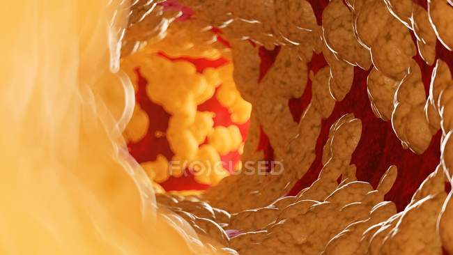 Медичні ілюстрація жир всередині людського артерія. — стокове фото