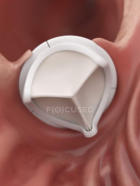 Медицинская иллюстрация искусственного сердечного клапана . — стоковое фото