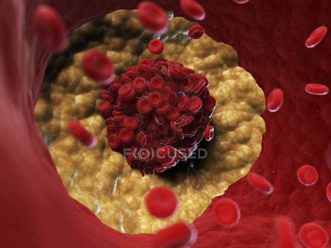 Illustrazione del coagulo di sangue lipidico nel sistema circolatorio . — Foto stock