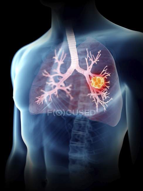 Ilustración del tumor pulmonar en silueta masculina transparente
. - foto de stock