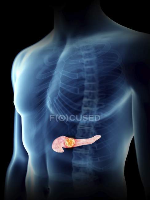 Illustration eines Bauchspeicheldrüsentumors in transparenter männlicher Silhouette. — Stockfoto