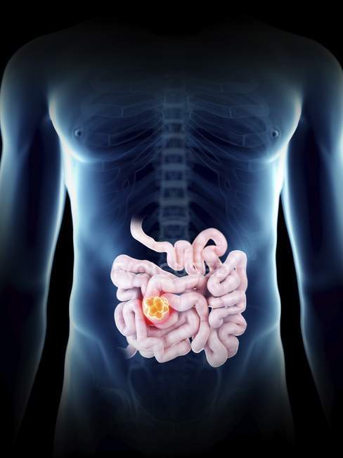 Ilustración del tumor del intestino delgado en silueta masculina transparente
. - foto de stock