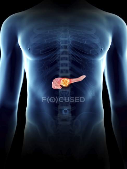 Illustrazione del tumore al pancreas nella silhouette maschile trasparente . — Foto stock