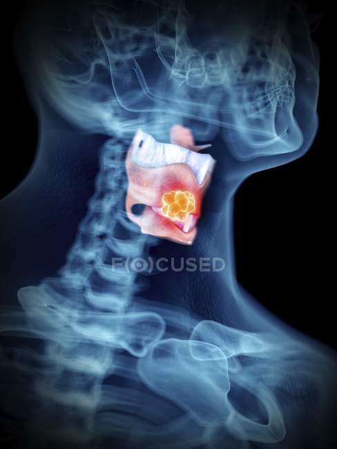 Ilustración en primer plano de la silueta azul transparente del cuerpo masculino con tumor de laringe de color . - foto de stock