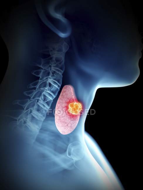 Ilustración en primer plano de la silueta azul transparente del cuerpo masculino con tumor tiroideo de color . - foto de stock