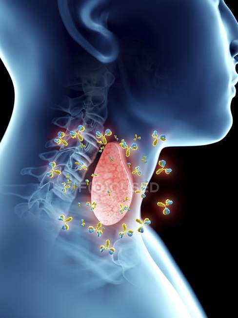Illustrazione della malattia tiroidea autoimmune nella silhouette della gola umana
. — Foto stock