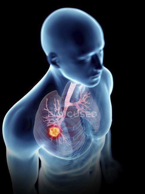 Ilustración de silueta azul transparente del cuerpo masculino con tumor pulmonar de color
. - foto de stock
