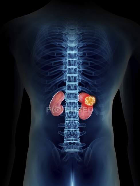 Ilustración de sección media de silueta azul transparente del cuerpo masculino con tumor renal de color . - foto de stock