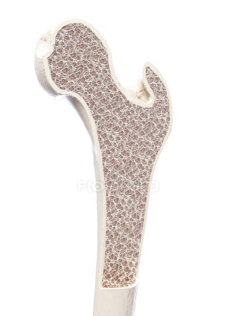 Illustrazione dell'osteoporosi ossea su sfondo bianco . — Foto stock