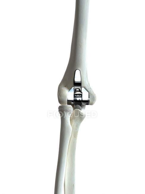 Ilustración del implante de codo en el esqueleto humano . - foto de stock