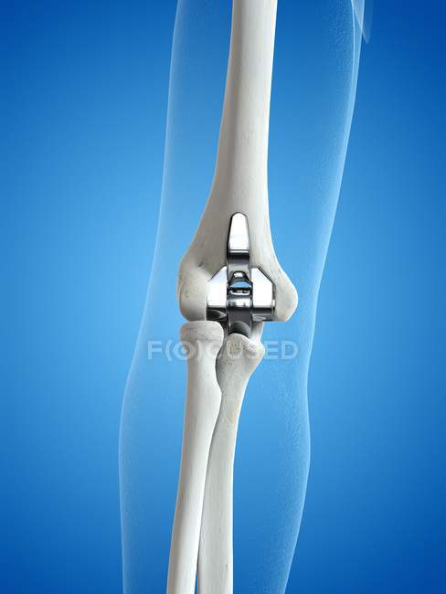 Illustrazione della protesi sostitutiva del gomito su fondo blu . — Foto stock